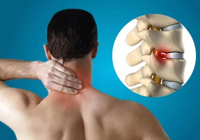 Osteohondroza materničnega vratu