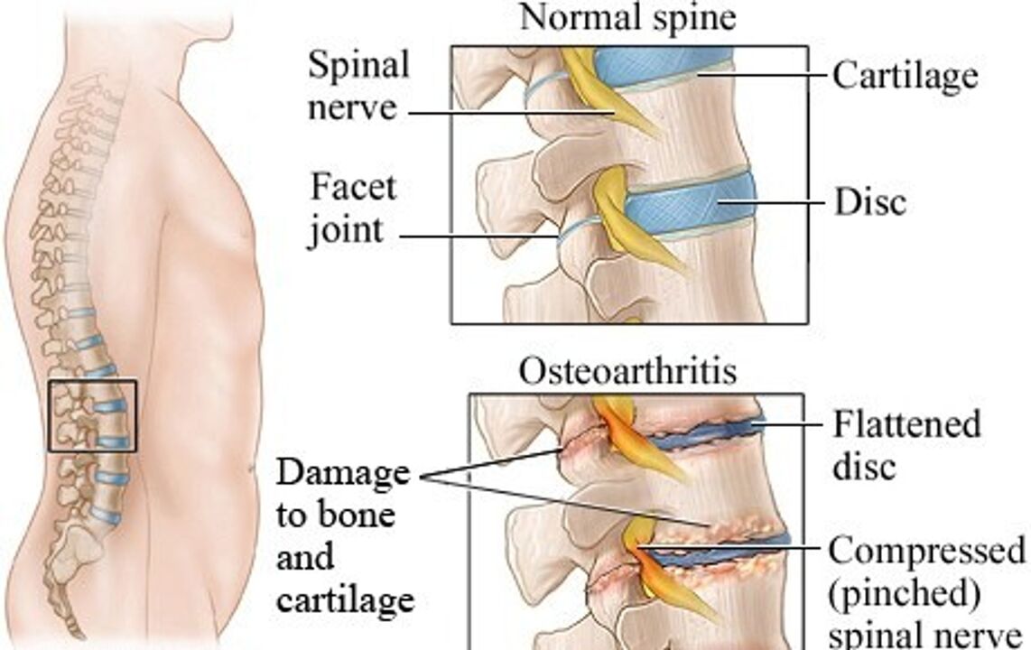 Razlika med zdravim diskom in diskom z osteohondrozo