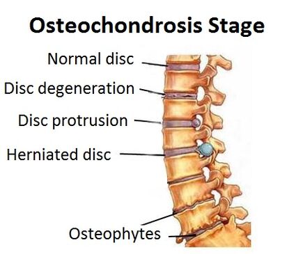 Stopnje osteohondroze